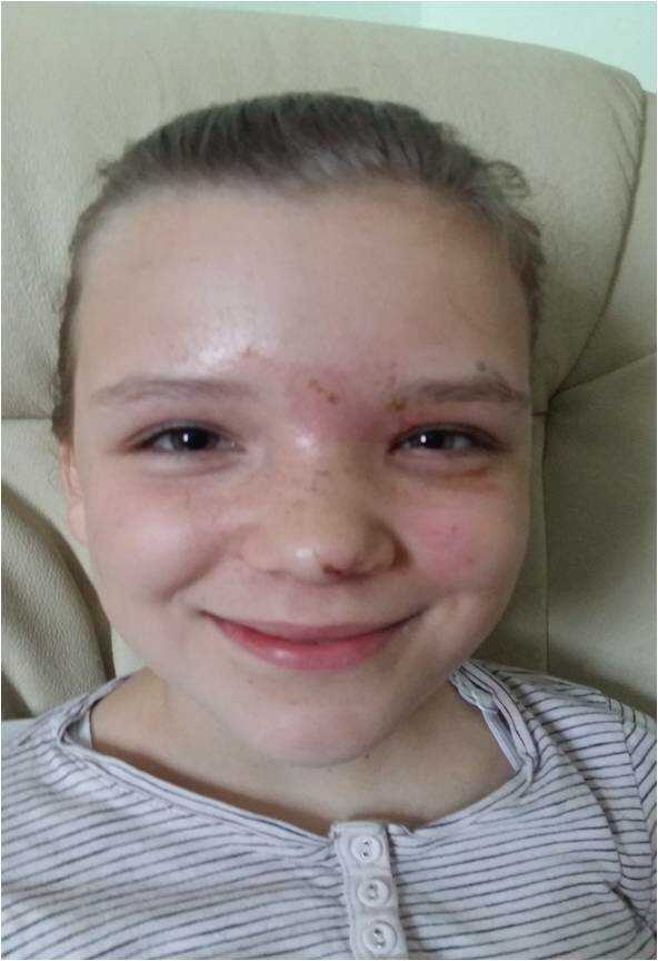 zranění léčba biorezonancí